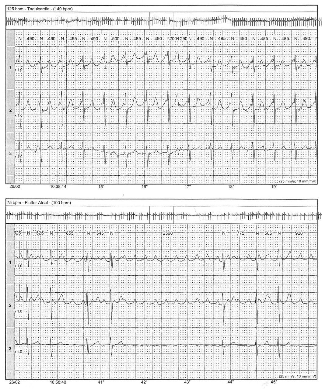 Paciente de 71 años hipertenso que presenta presíncopes por Aleteo Auricular con alto grado de BAV