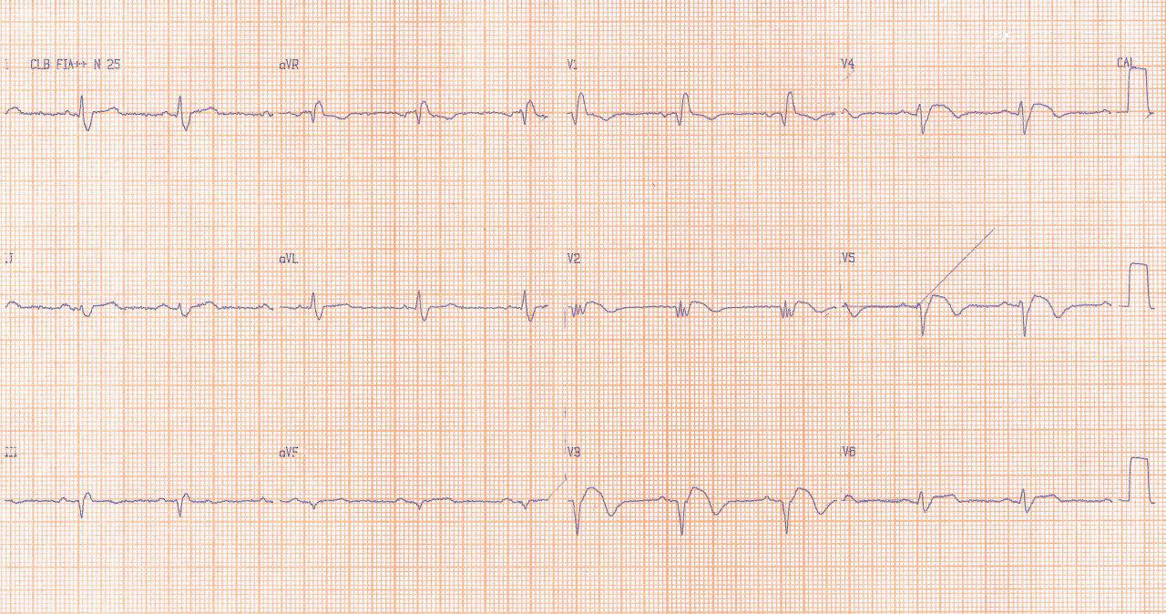 ECGs de paciente que cursa cuarto día de evolución de IAM con reperfusión  no exitosa que desarrolla aneurisma de VI con arritmias ventriculares