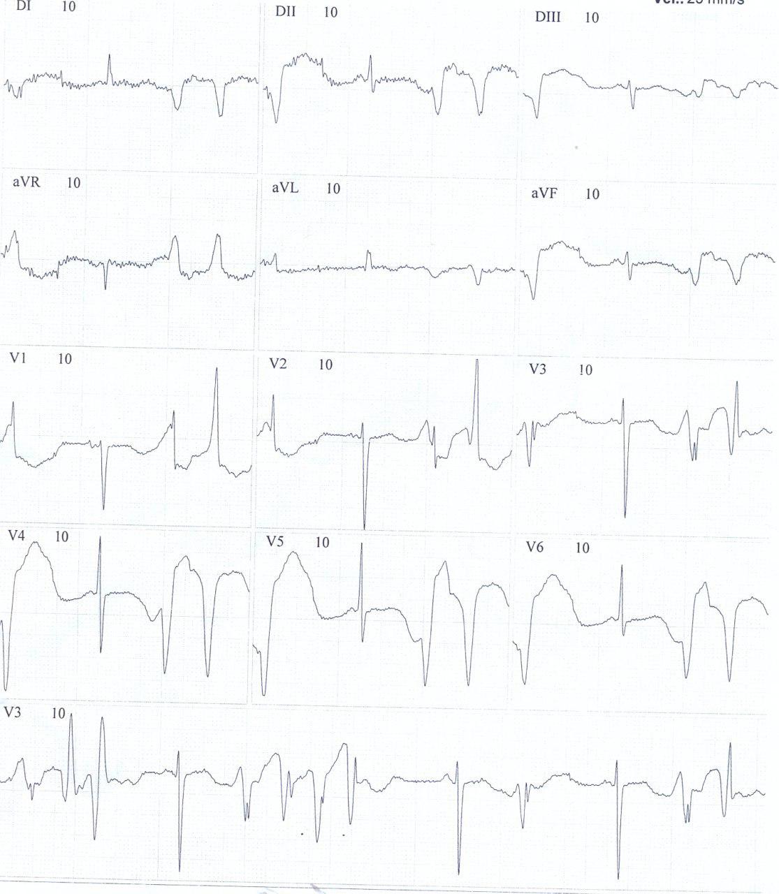 Mujer portadora de leischmaniasis cutánea en tratamiento con antimoniato de meglumina, con severa hipopotasemia que presenta mareos, debilidad y episodios sincopales que mejoran con el tratamiento
