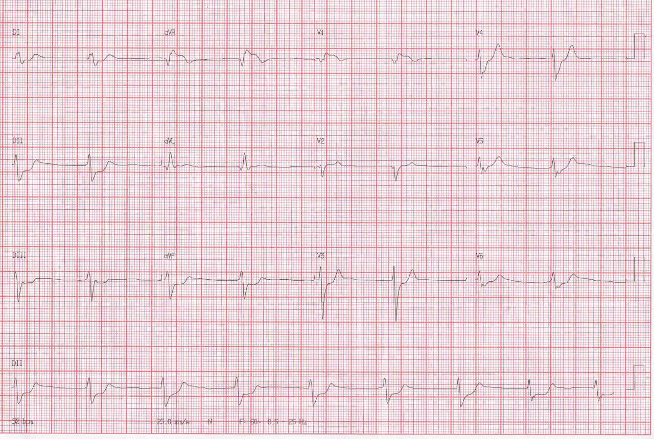 Paciente de 71 años con angor prolongado y edema agudo de pulmón que presenta lesión de TCI y DA que son angioplastiadas con mejoría del cuadro