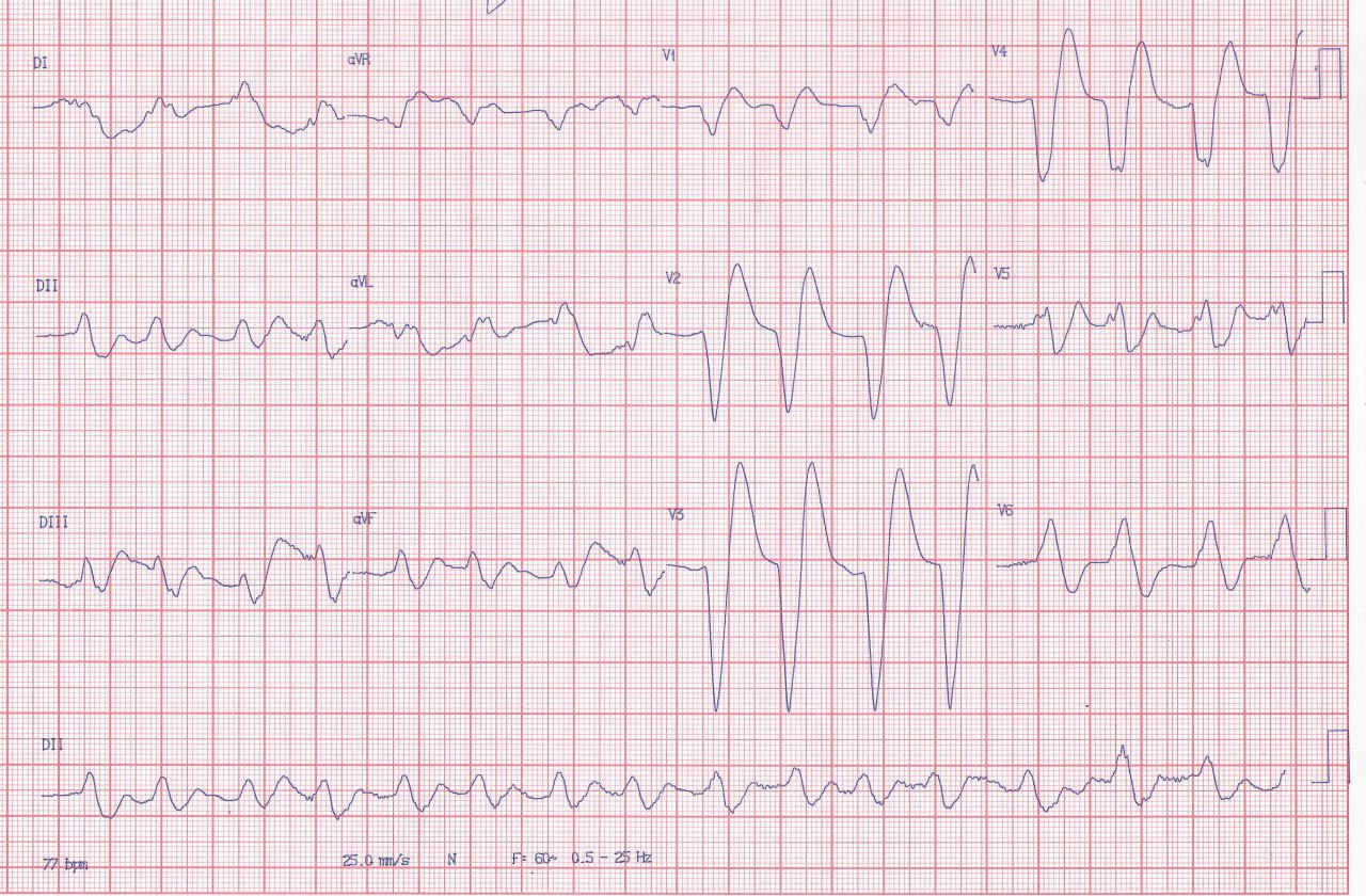 Paciente de 63 años con cuadro de insuficiencia cardíaca que presenta disnea y disminución del nivel de consciencia que presenta marcada hiperpotasemia