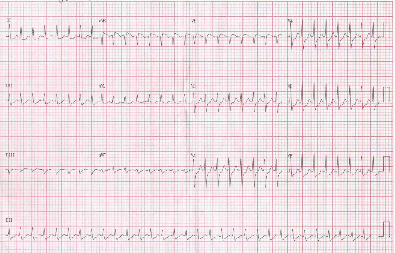 Mujer de 65 años con palpitaciones recurrentes por taquicardia por doble fisiología nodal que se controla con adenosina presentando marcada prolongación del AH