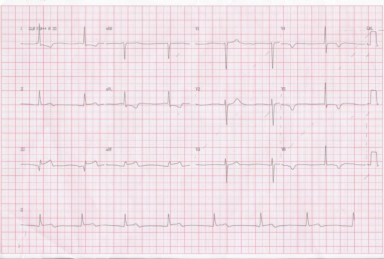Mujer de 67 años con angor prolongado y síncope que presenta disociación isorrítmica y trombo de gran tamaño en la CD