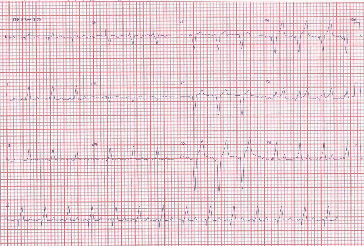 Paciente de 71 años portador de marcapasos con FR y angina típica presenta potasemia  y troponina normales con puente muscular sobre DA