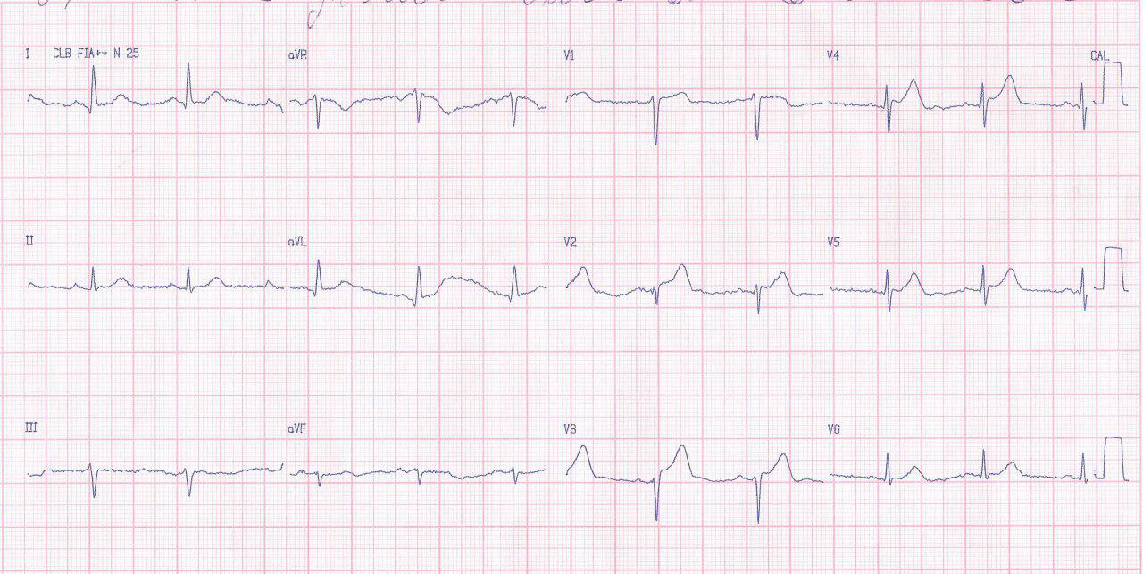 Mujer de 61 años con angor prolongado que presenta SCA por oclusión con trombo en la DA proximal