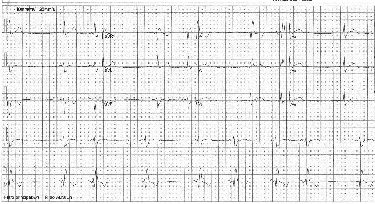 Paciente de 76 años con antecedentes de cirugía de revascularización miocárdica que presenta episodios sincopales