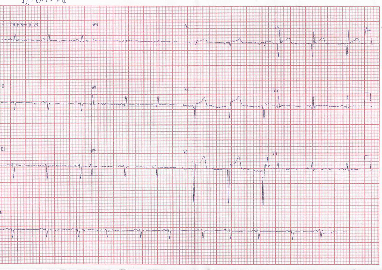 Hombre de 62 años, diabético, que presenta disnea, cuyo ECG muestra un IAM anterior en evolución
