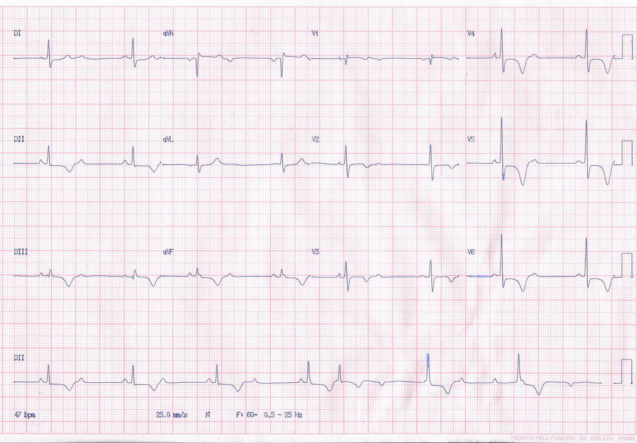 Paciente de 74 años que presenta episodio sincopal por presentar en forma alternante BAV 2:1 y BAVC