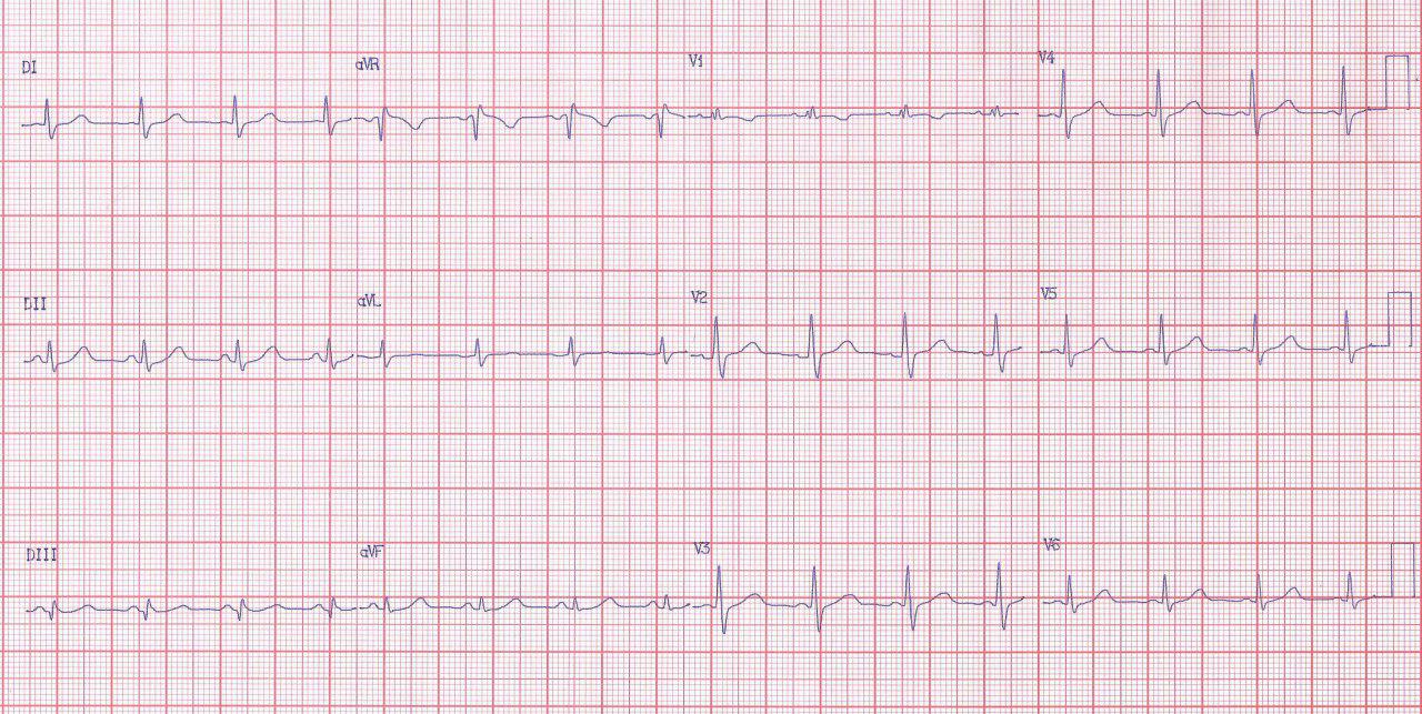 Mujer de 37 años con disnea que presentacon 2º ruido cardíaco desdoblado permanente y fijo por  CIA tipo ostium secundum