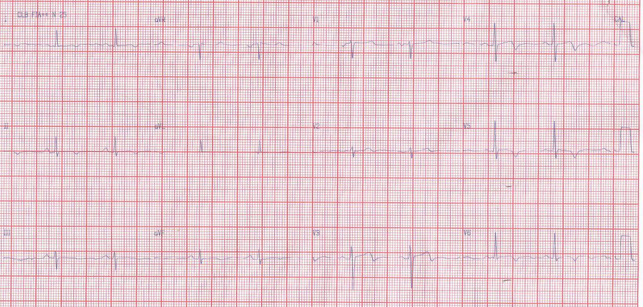 Paciente de 76 años con FR que presenta angina inestable con presencia de patrón ECG de Wellens tipo I por suboclusión de DA proximal