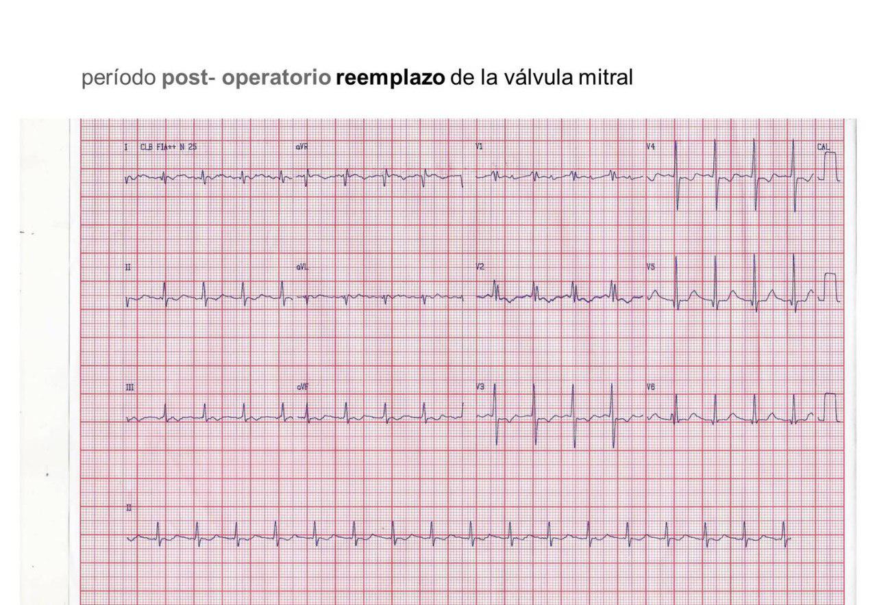 ECG de postoperatorio de reemplazo valvular mitral donde se observa taquicardia auricular con BAV 2:1 corroborada en EEF