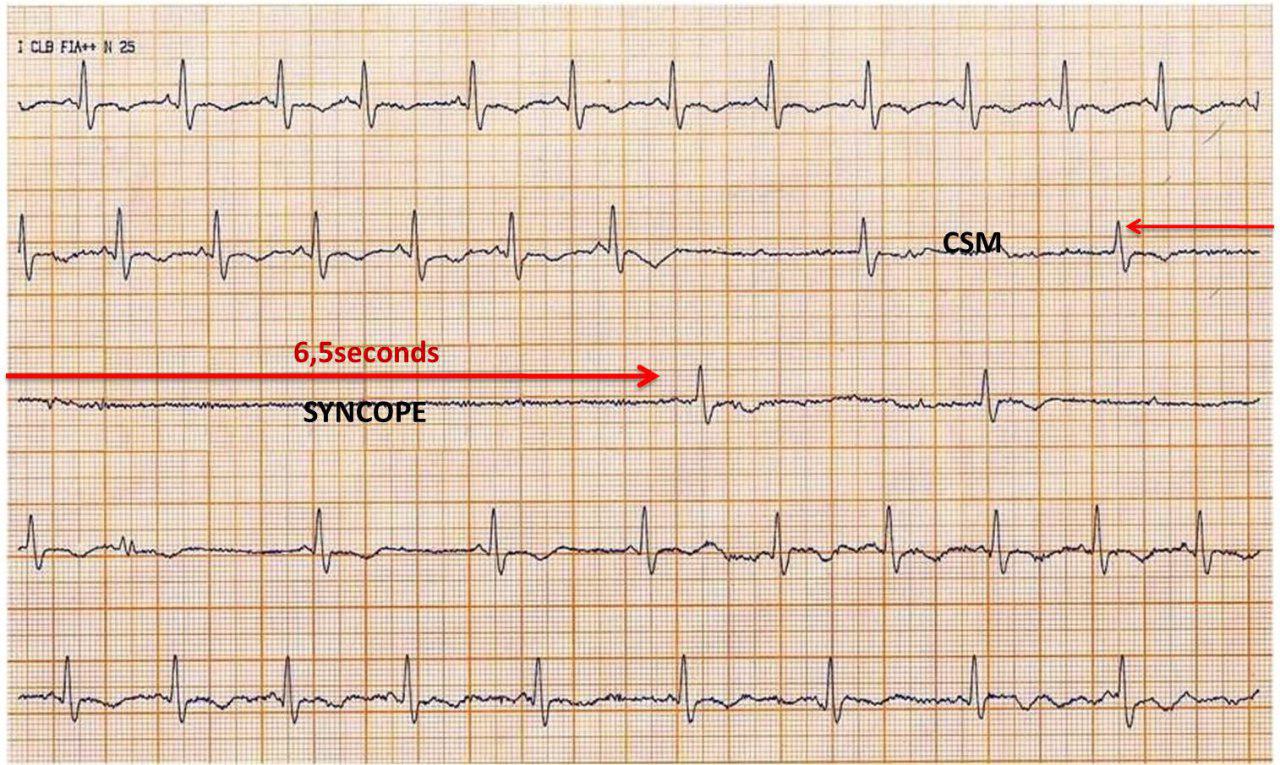 Paciente de 75 años sin cardiopatía estructural que presenta episodios sincopales por hipersensibilidad del seno carotídeo