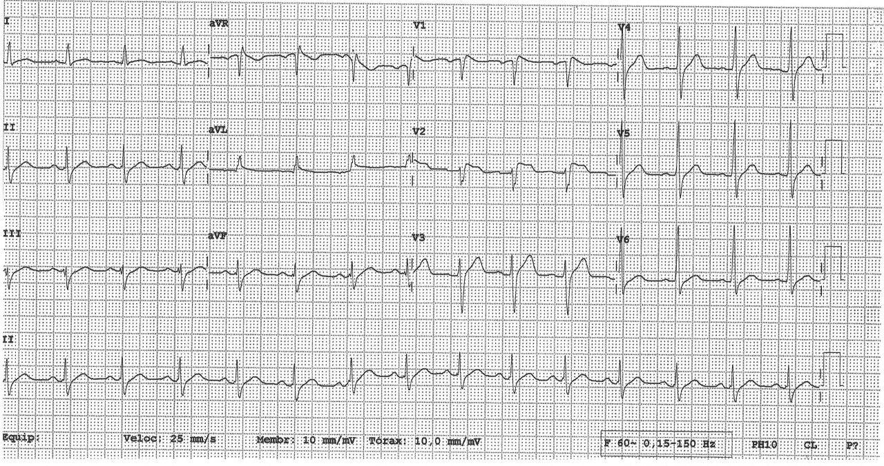 Paciente de 42 años, alcoholista, con antecedentes de síncopes en la infancia, con malestar precordial, enzimas y troponina normales, que presenta patrón Brugada ECGráfico