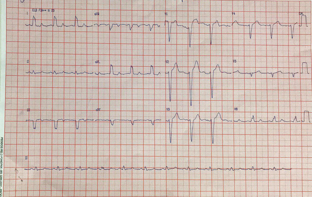 Hombre de 79 años con angor prolongado que presenta BCRI cursa cuadro de SCA por oclusión de DA después de 1º diagonal