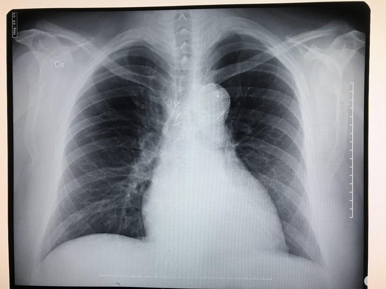 Paciente de 43 años portador de síndrome de Marfan con antecedente de procedimiento de Bentall en 2004 y endoprótesis aórtica en 2013 por disección aórtica