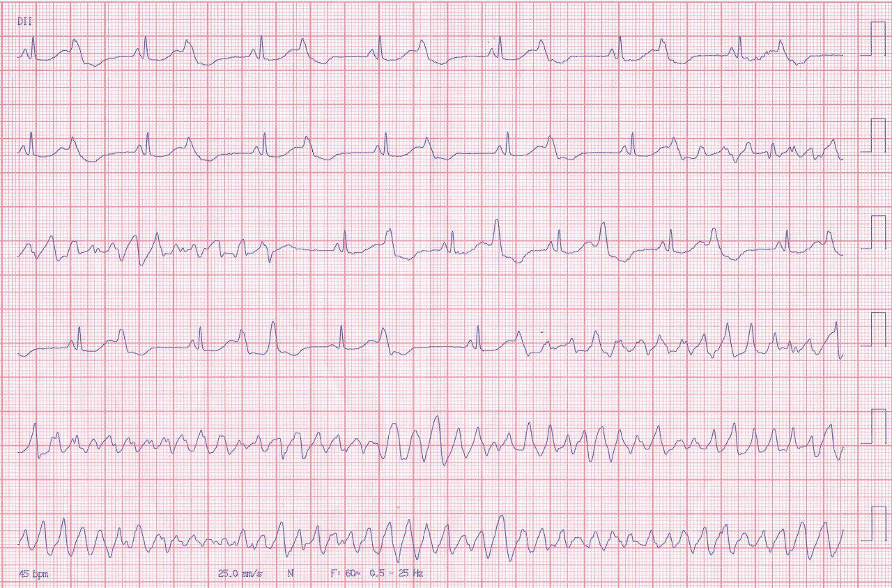 Mujer de 32 años que presenta episodios sincopales por ser portadora de síndrome de QTL tipo 2 y episodios de TdP