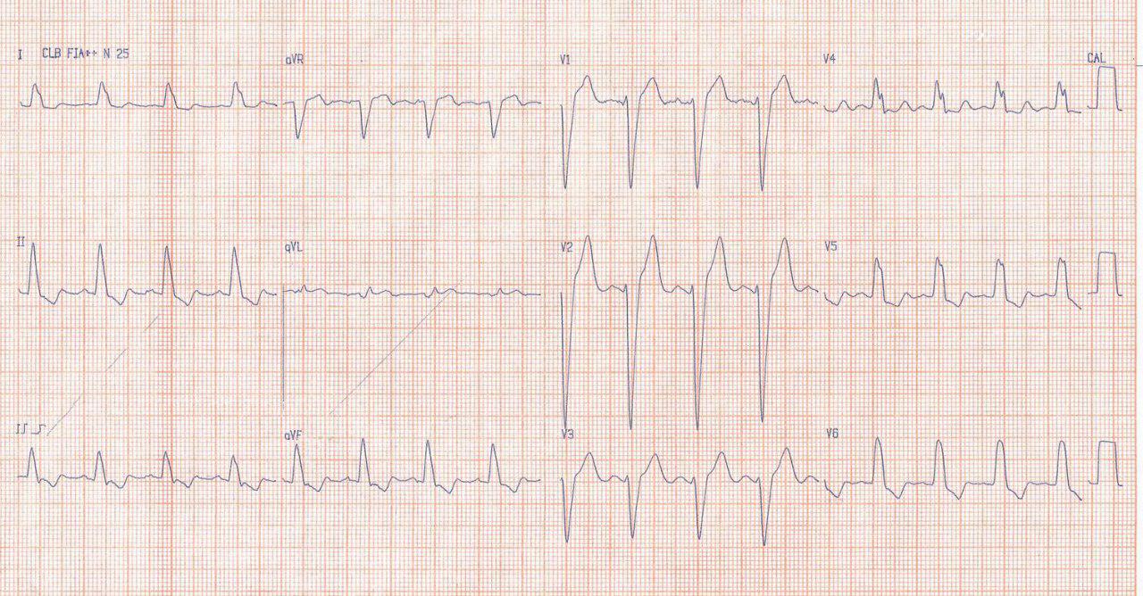 ECG de paciente con CCG normal que muestra BCRI verdadero o estricto