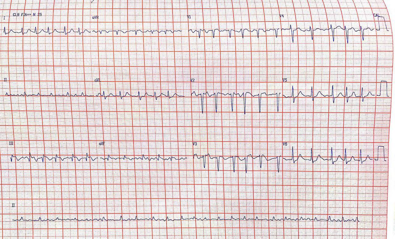 Mujer de 31 años con patrón S1Q3T3 por TEP y presencia de trombo móvil en AD que evoluciona al óbito