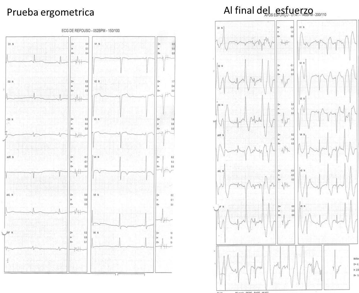 Paciente de 44 años con antecedentes de episodios de pérdida de conciencia durante esfuerzos que presenta taquicardia ventricular catecolaminérgica