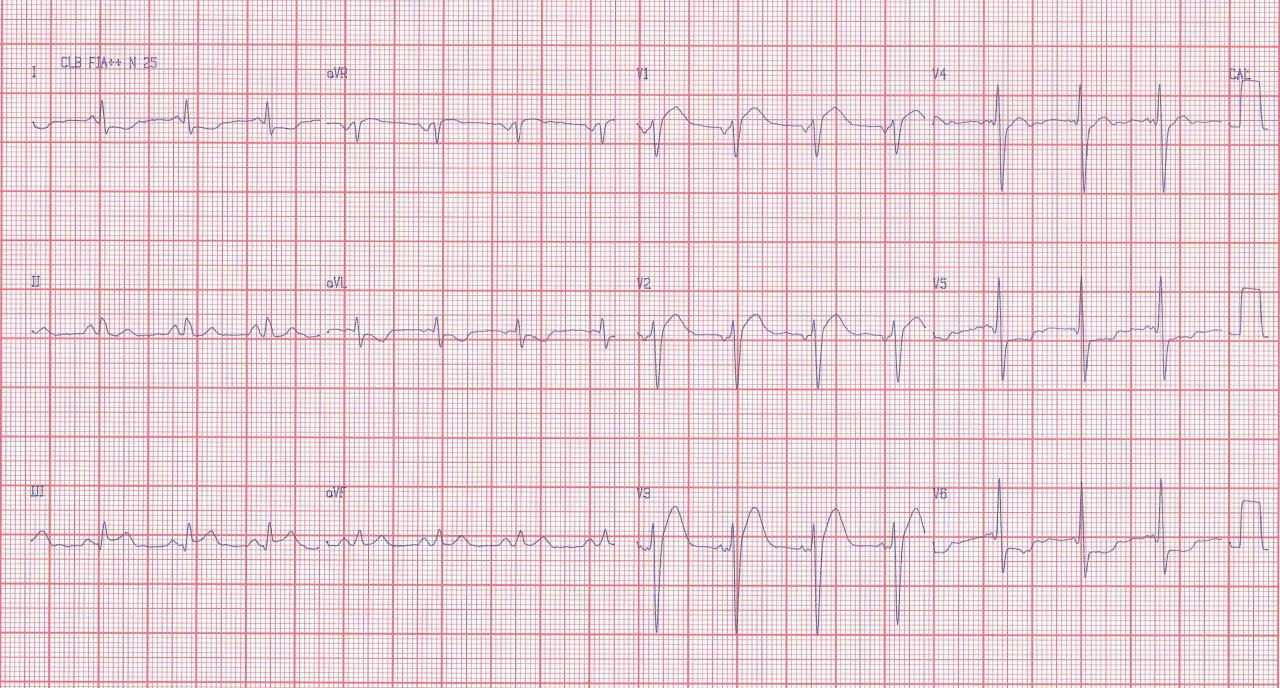Hombre diabético de 55 años con angor prolongado por SCA por presencia de trombo en CD