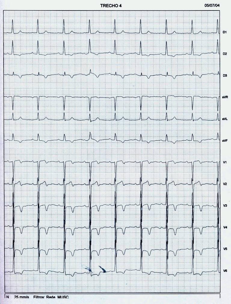Paciente de 68 años portador de MP en el que se observa fenómeno de Memoria Cardíaca ausente en ECGs previos