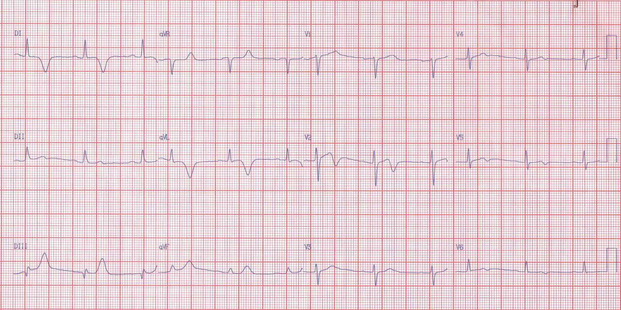 Mujer de 69 años portadora de hepatitis C con anemia y plaquetopenia que presenta angor prolongado vinculado al hallazgo de un puente muscular sobre la arteria DA