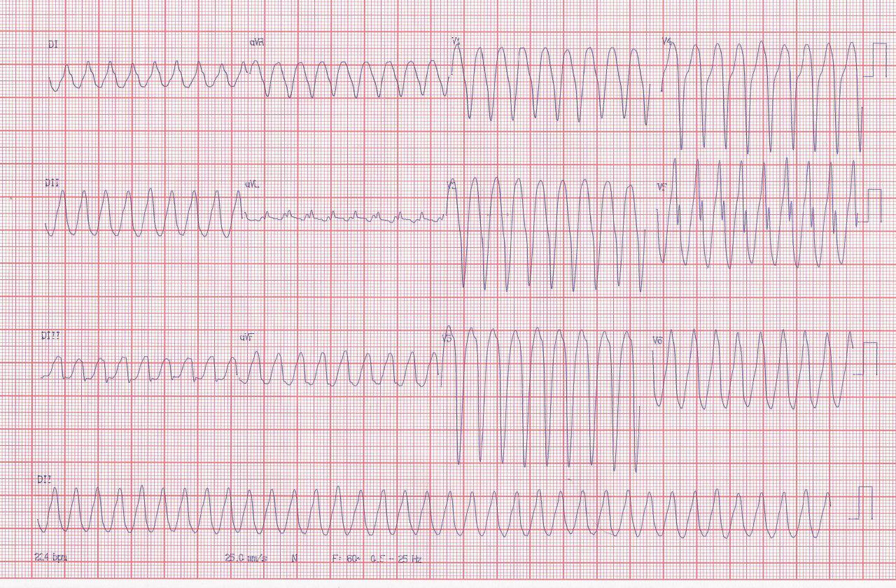 Hombre de 61 años con antecedentes de FA crónica que presenta dolor precordial, sudoración y presíncope y arterias coronarias normales