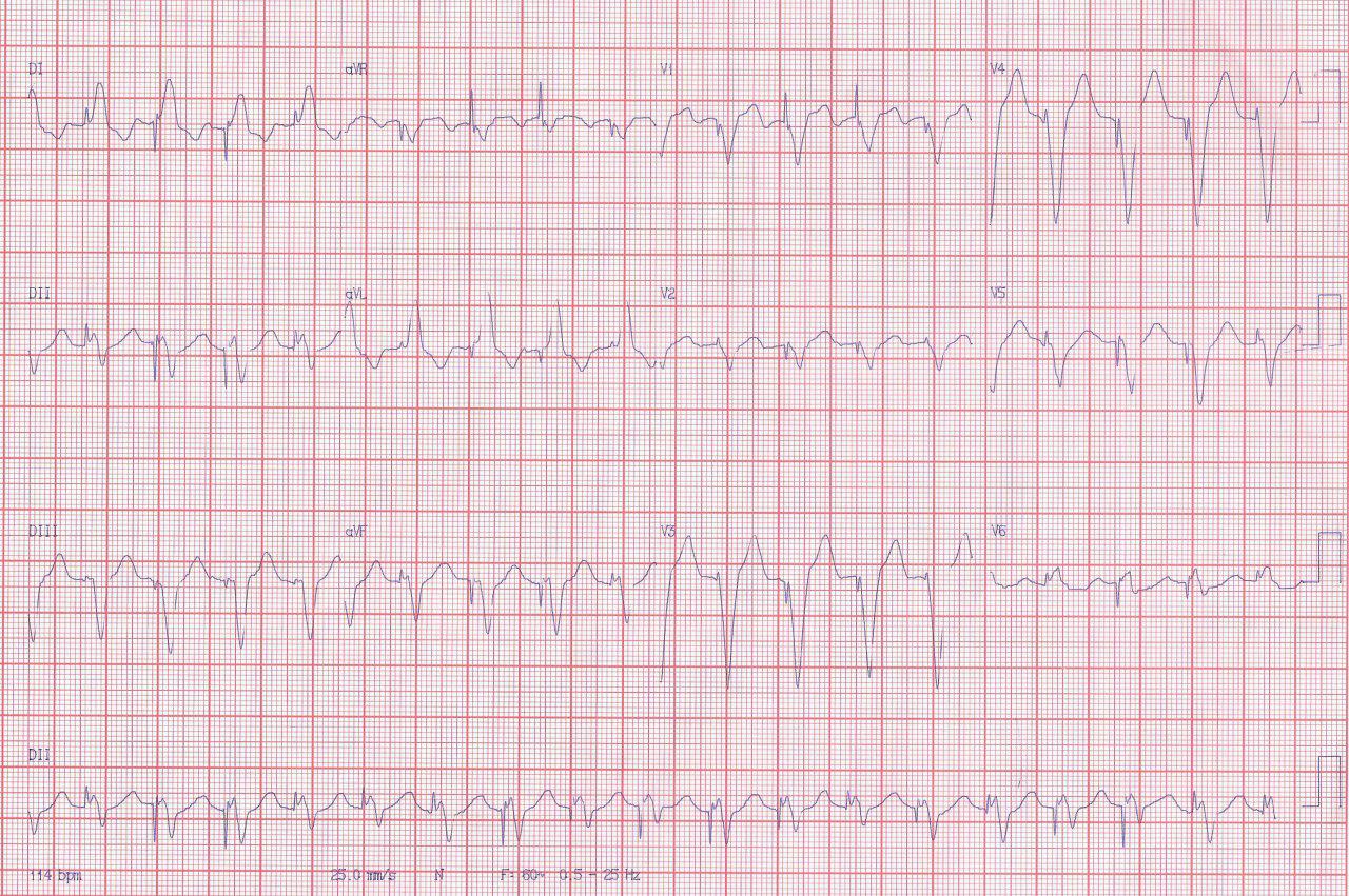 Mujer de 71 años con factores de riesgo y MP implantado que presenta angor prolongado por enfermedad aterotrombótica multivasos
