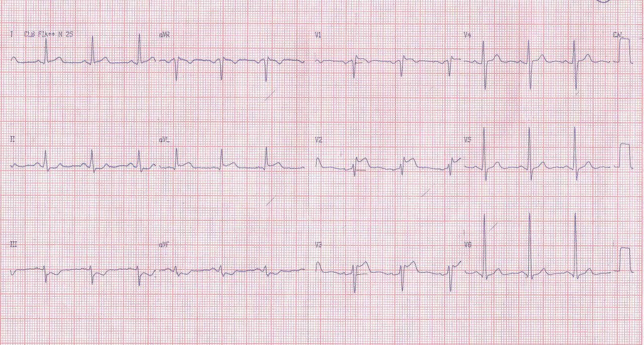 Hombre de 46 años que presenta angor prolongado constatándose lesión del 40% en arteria Diagonal con presunción de espasmo sobre la misma