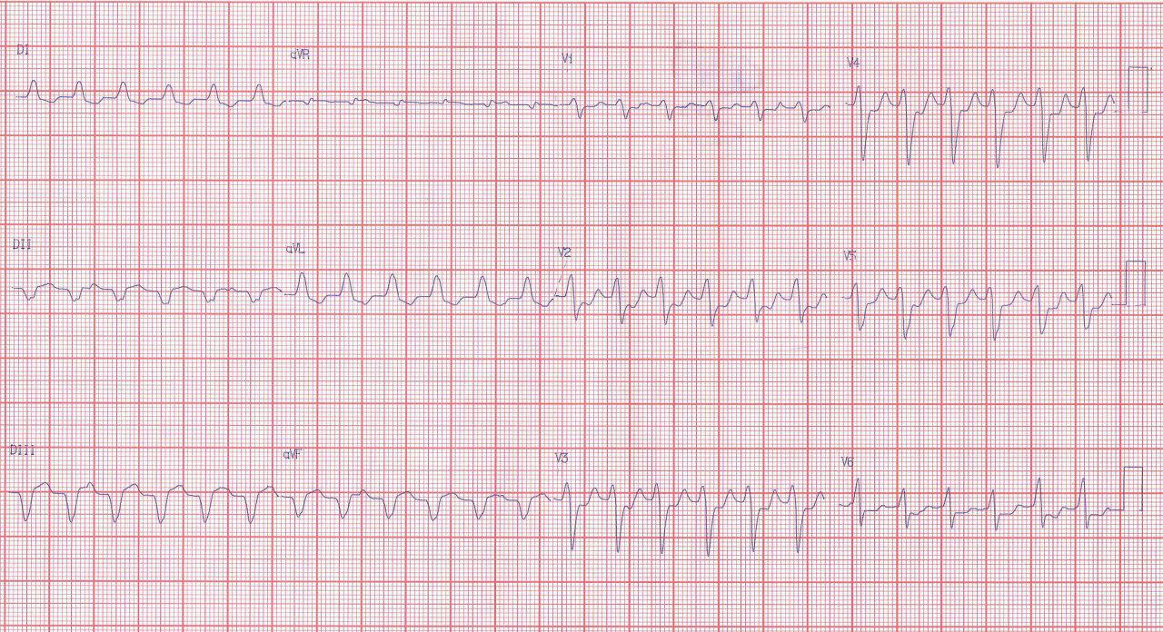 Hombre de 76 años con antecedente inmediato de SCA que presenta taquicardia ventricular por presencia de trombo en arteria Cx