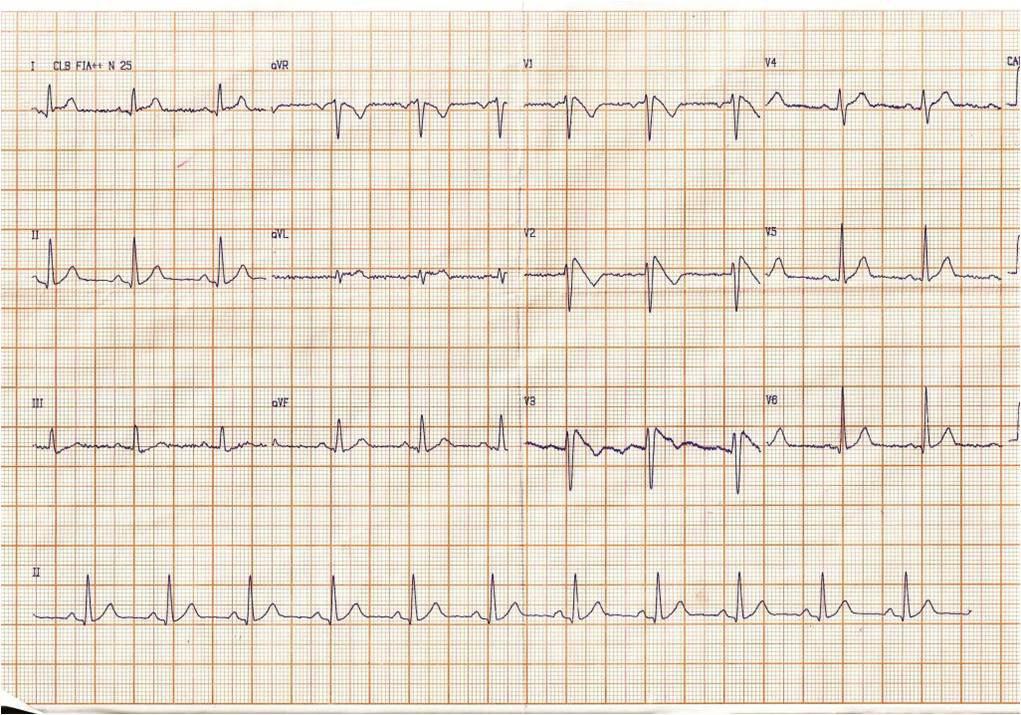 Dos pacientes portadores de patrón ECG de Brugada con diferente probabilidad de presentar arritmia ventricular