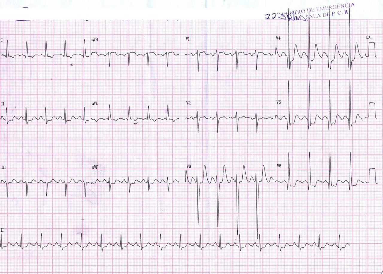 Mujer de 47 años con angor, disnea y episodio sincopal y CCG normal que presenta miocardiopatía hipertrófica obstructiva