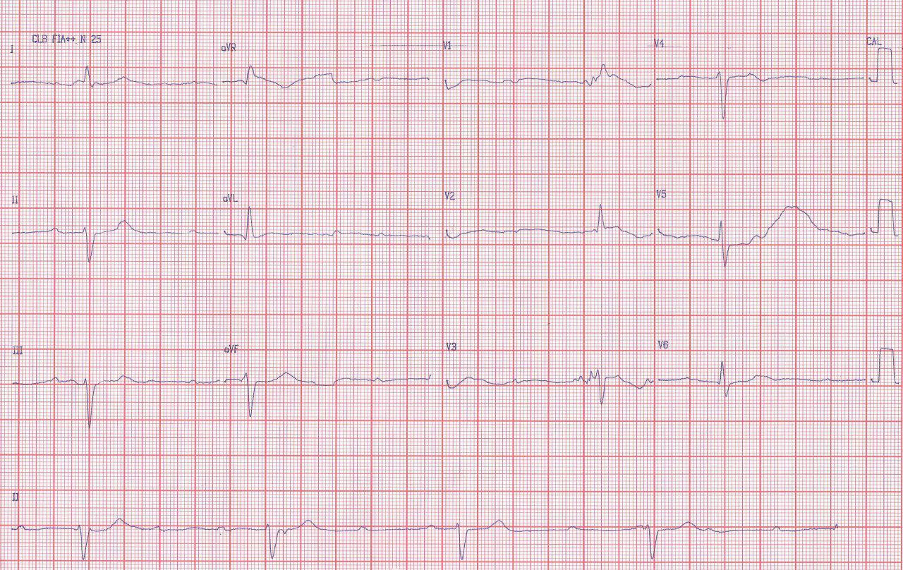 Anciana de 89 años con episodios de pérdida de consciencia y relajación esfinteriana por presencia de BAVC que requiere implante de MP y episodios de T de P por QTL debido a bradicardia