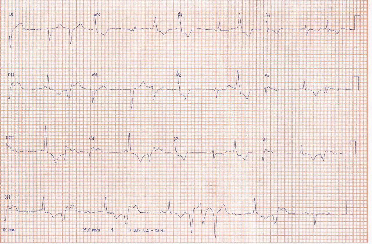Hombre de 56 años con factores de riesgo y antecedentes familiares de enfermedad coronaria que presenta dos episodios sincopales