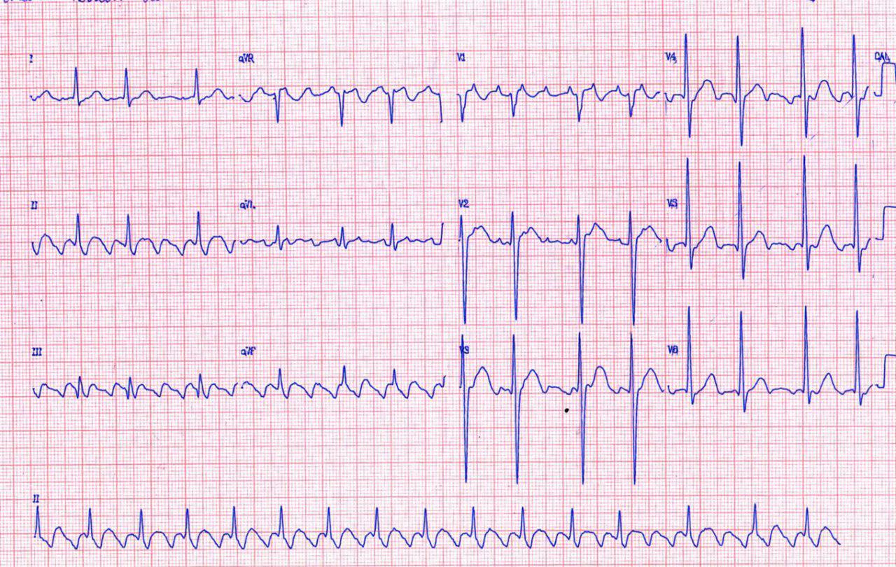 Paciente de 69 años que es tratado con 600 mg de propafenona que induce un aleteo auricular con conducción 1:1