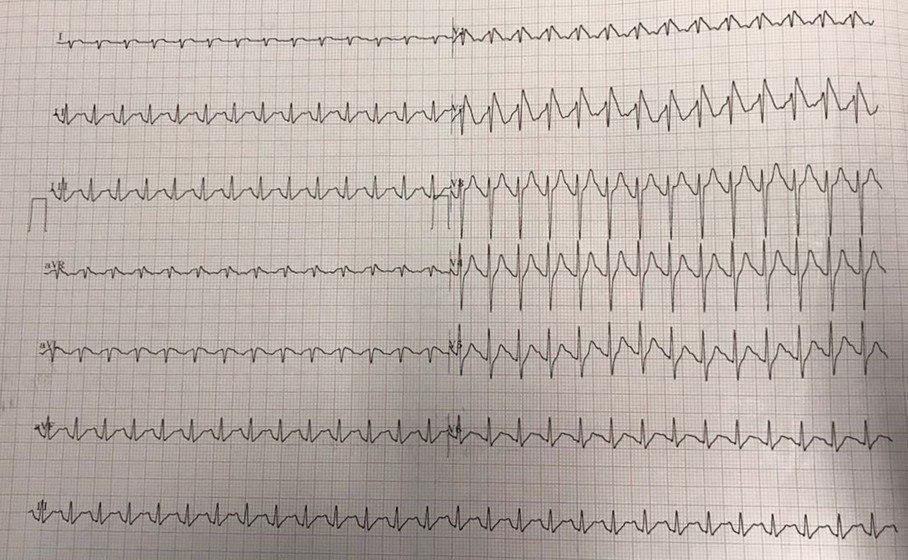 Paciente de 38 años que presenta respiración agónica e ingresa al Hospital en PCR por FV que es reanimada con constatación de Síndrome de Brugada