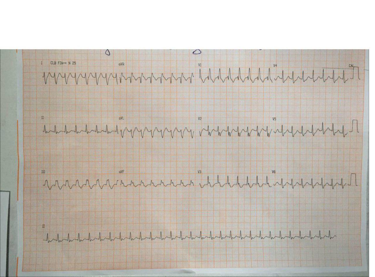 Mujer de 56 años medicada con hormona tiroidea que presenta taquicardia por reentrada intranodal con BCRD que responde a adenosina