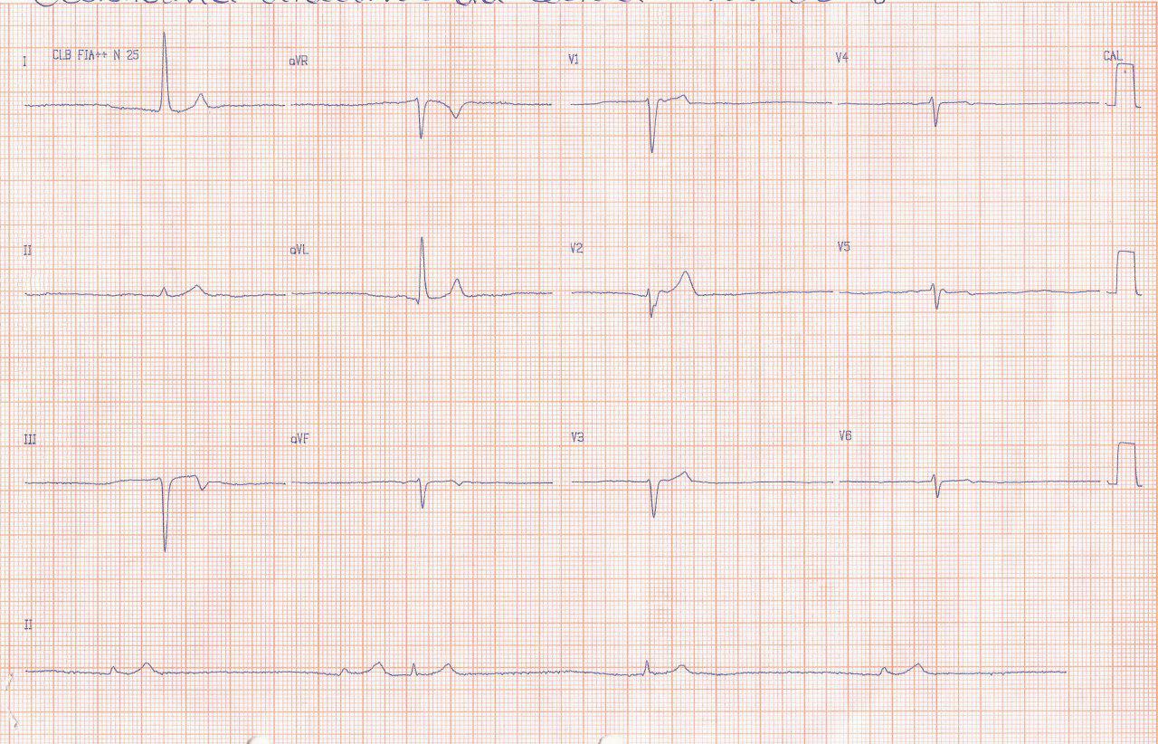 Mujer de 78 años polimedicada recibiendo carvedilol con sensación de desmayo por presentar ritmo de la unión con muy baja frecuencia ventricular que desaparece al suspender el b bloqueante