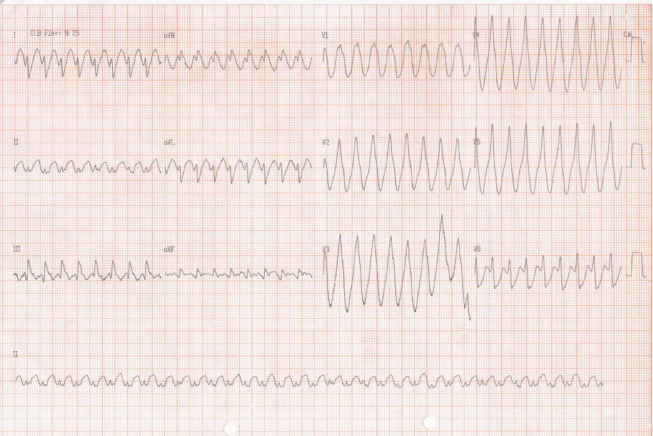 Hombre de 84 años con angor prolongado que se presenta con TV y con hipoquinesia lateral y aumento de troponina constatándose lesión con trombo en arteria Cx