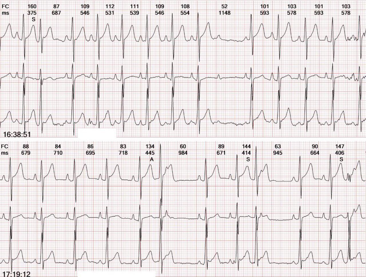 Joven de 20 años con palpitaciones por extrasístoles hisianas con conducción oculta anterógrada y retrógrada