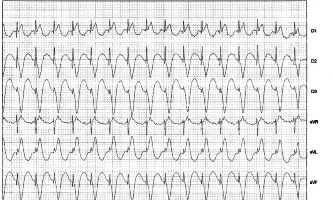 Paciente portador de marcapasos que presenta aleteo auricular que es sensado por el dispositivo produciendo una taquicardia del MP que cesa con un imán