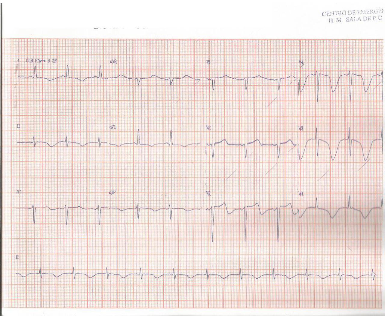 Paciente hipertenso de 67 años con somnolencia por presentar hemorragia subaracnoidea con típicos cambios de QT prolongado y ondas T negativas