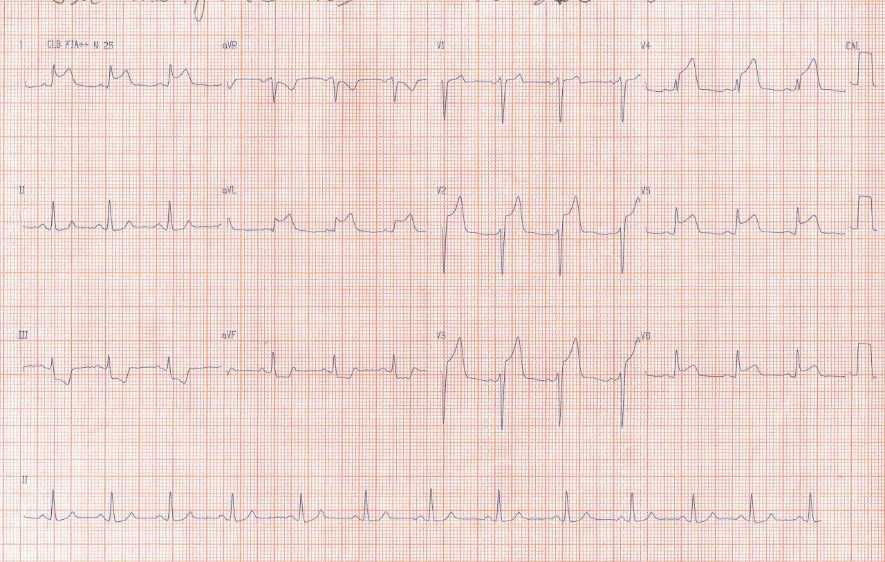 Paciente de 23 años con antecedentes familiares de enfermedad coronaria, consumidor de drogas ilícitas que presenta SCA por presencia de trombo en DA y que previo a CCG muestra un RIVA por posible reperfusión espontánea parcial