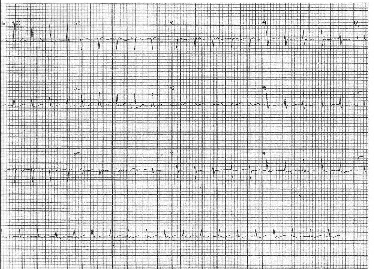 Paciente de 83 años portadora de MP bicameral que presenta TRAVO que inhibe la estimulación y que cede con adenosina