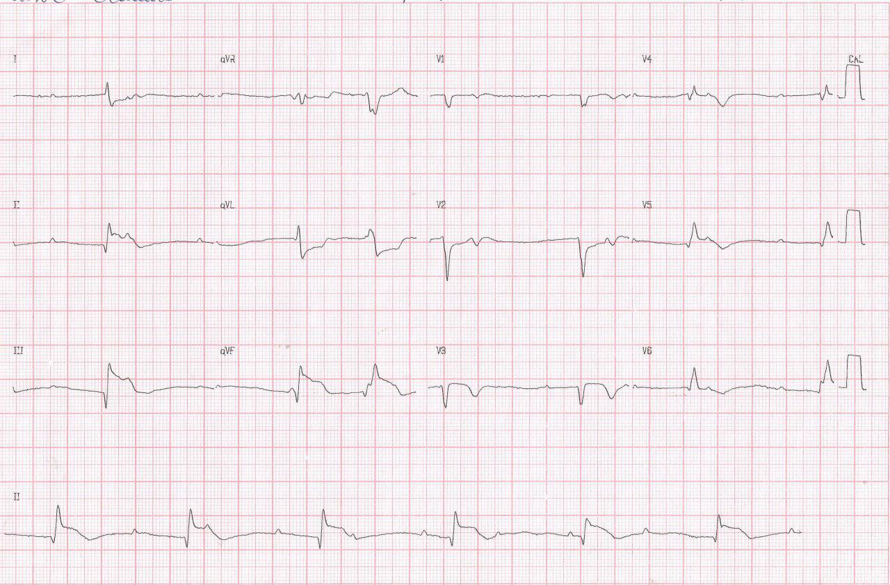 Hombre de 76 años que cursa con IAMCEST complicado con BAVC por compromiso de CD y VD