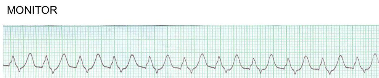 Paciente hipertenso y diabético que cursa con severa hiperkalemia de 8,3 mEq/l
