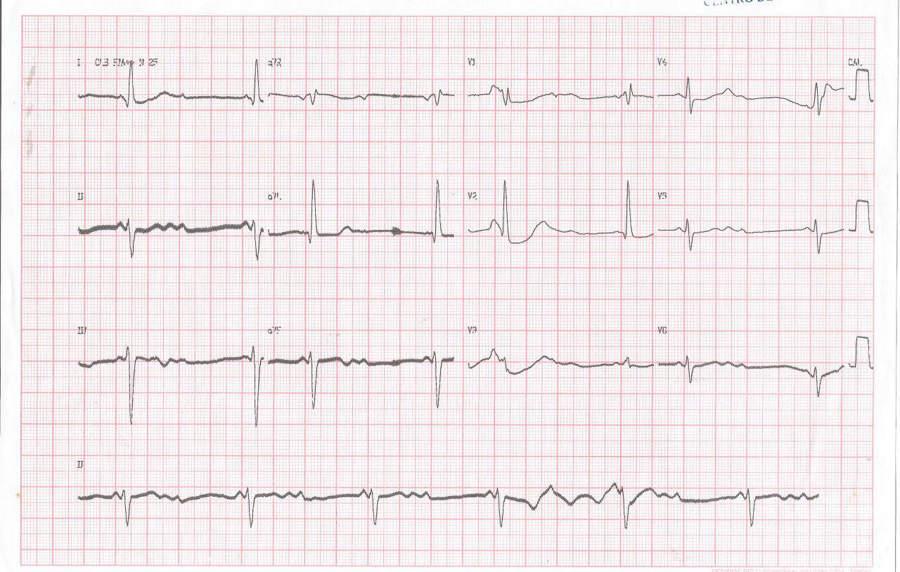 Anciana de 81 años que presenta síncope con traumatismo de cráneo y hematoma subdural que presenta bloqueo trifascicular y bloqueo posteroinferior intermitente