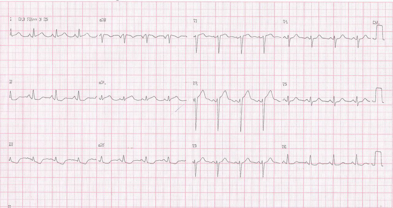 Paciente masculino de 56 años con angor de reciente comienzo que muestra pseudonormalización de la onda T como manifestación isquémica