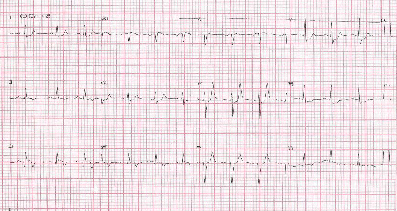 Mujer de 84 años con disnea progresiva y hallazgo de hipocinesia ínferolateral con CCG que presenta TCI = 80% distal, DA 90% ostial, Cx 100% proximal, CD 99% ostial en la que se realiza ATC con stent a CD con flujo final TIMI III