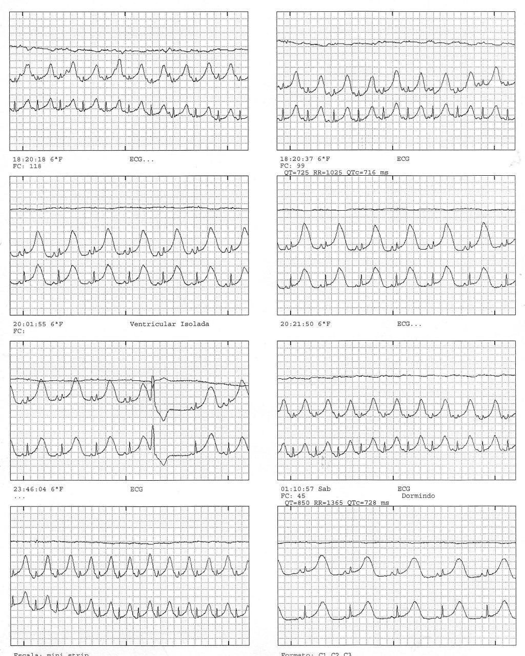 Mujer de 21 años que presenta episodios sincopales por síndrome de QTL tipo I